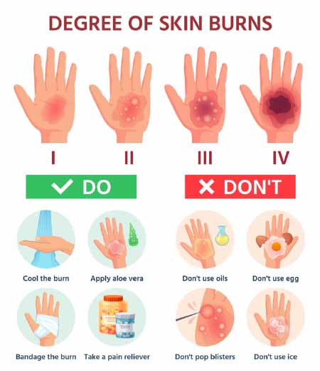 Safety Tip of the Week – Treating Burns – Safety Matters Weekly
